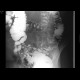 Diverticulosis of the colon: RF - Fluoroscopy